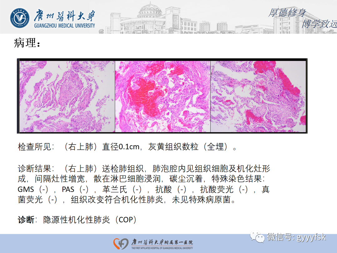 【病例】隐源性机化性肺炎1例CT影像-8