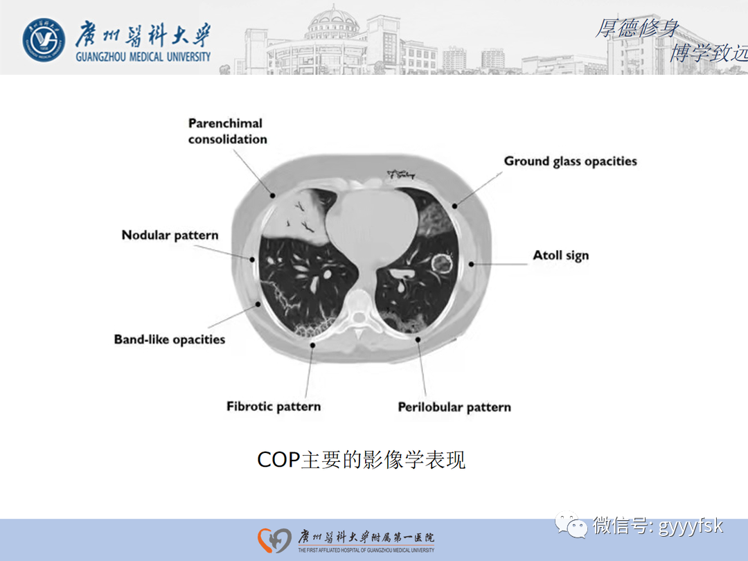 【病例】隐源性机化性肺炎1例CT影像-12