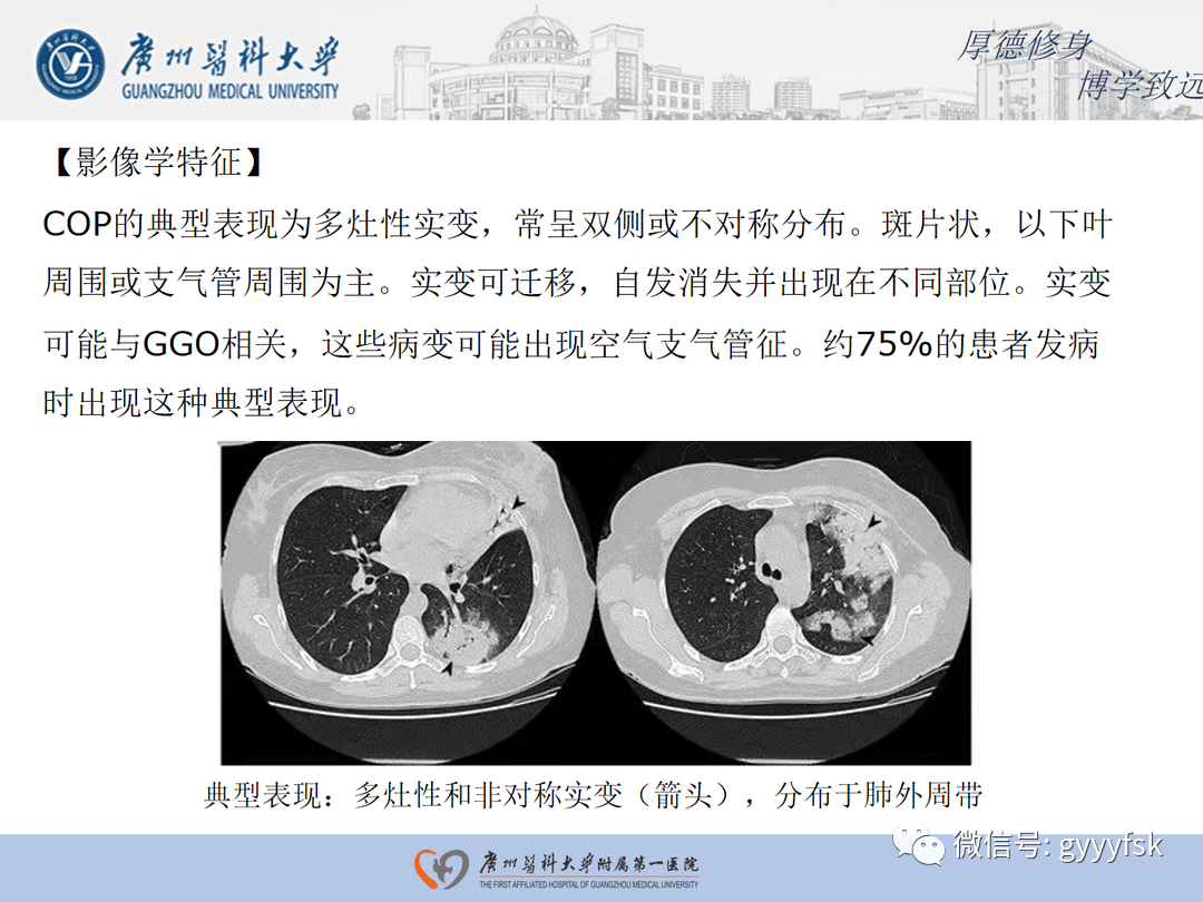 【病例】隐源性机化性肺炎1例CT影像-13