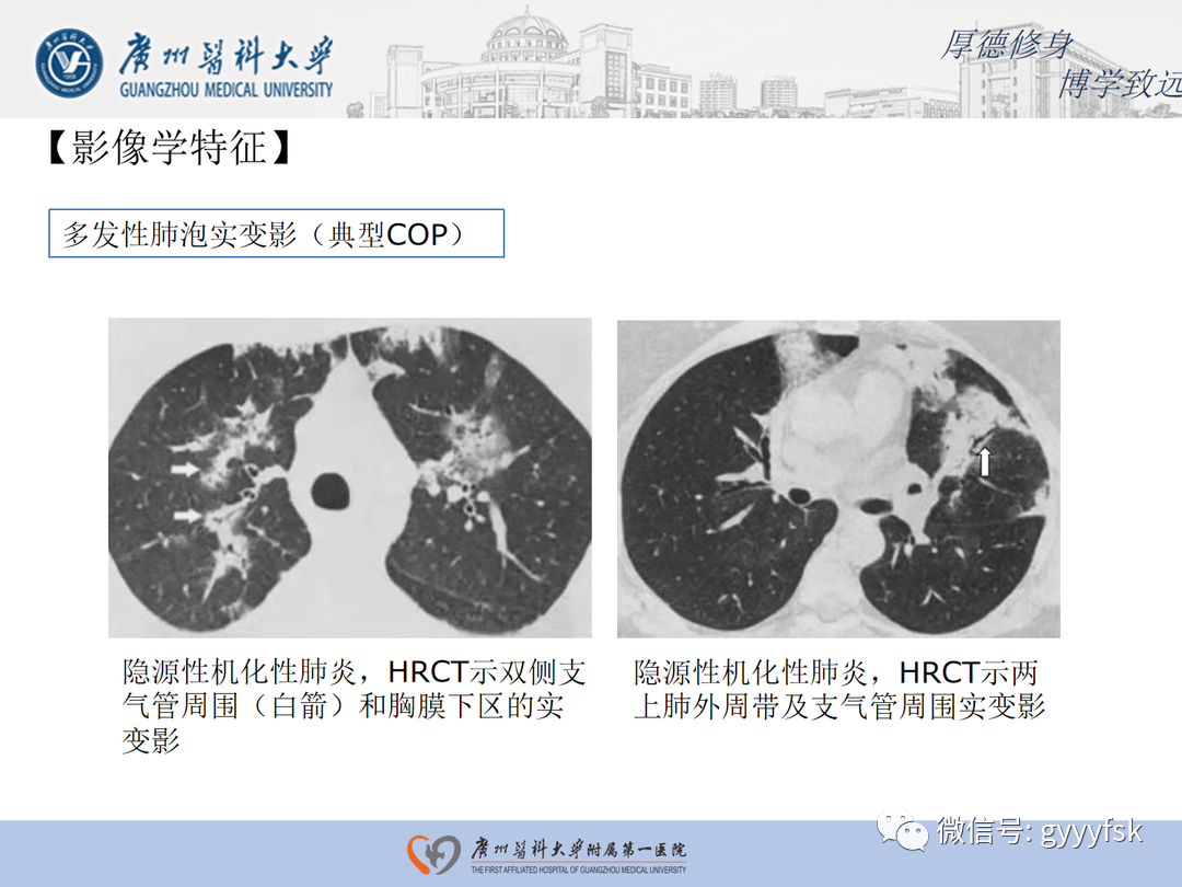 【病例】隐源性机化性肺炎1例CT影像-15