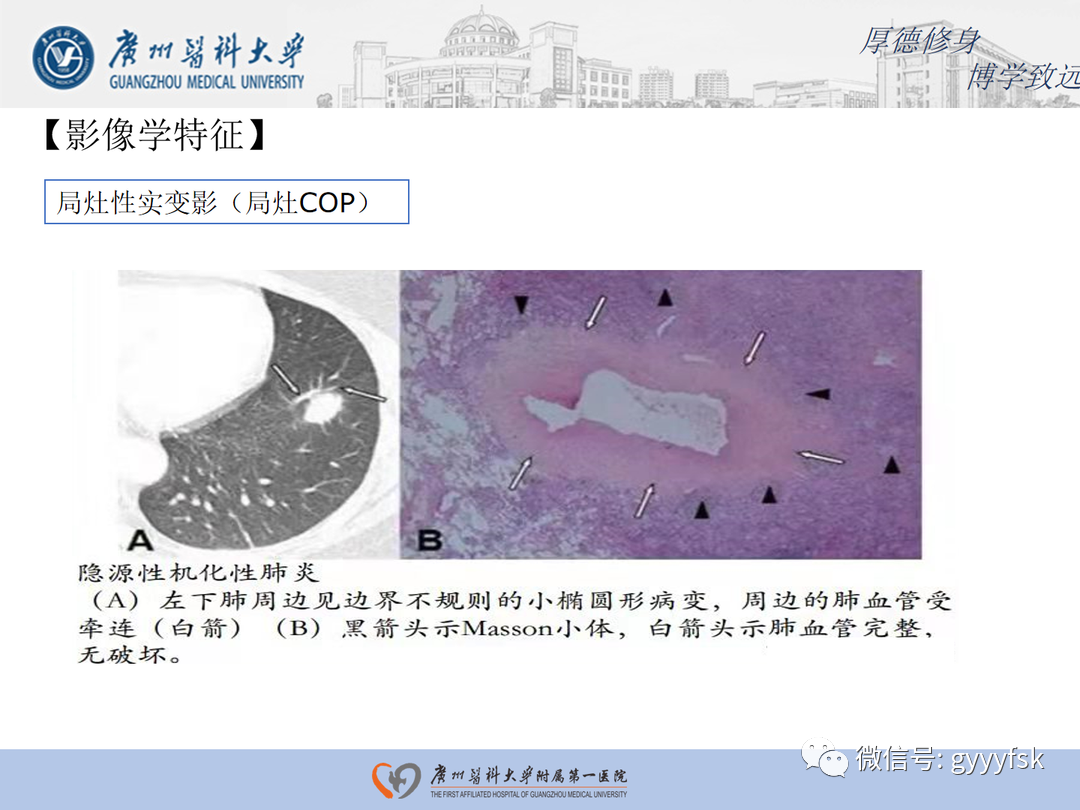 【病例】隐源性机化性肺炎1例CT影像-16