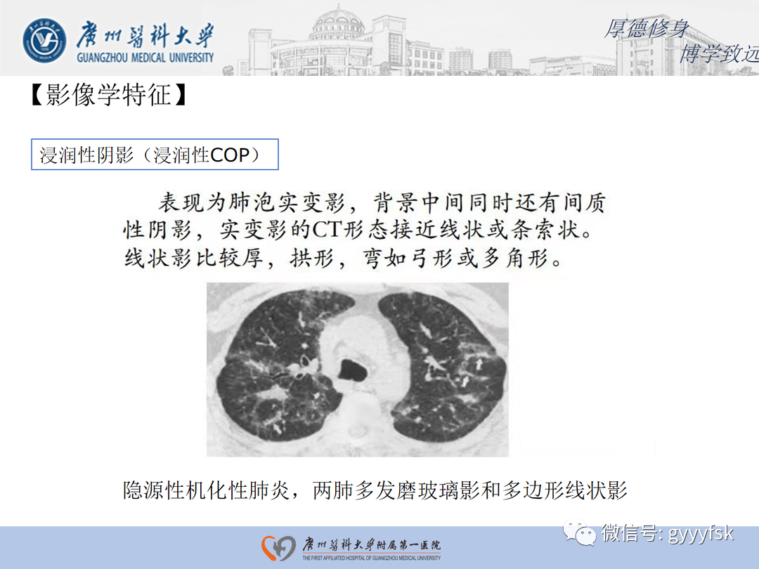 【病例】隐源性机化性肺炎1例CT影像-17