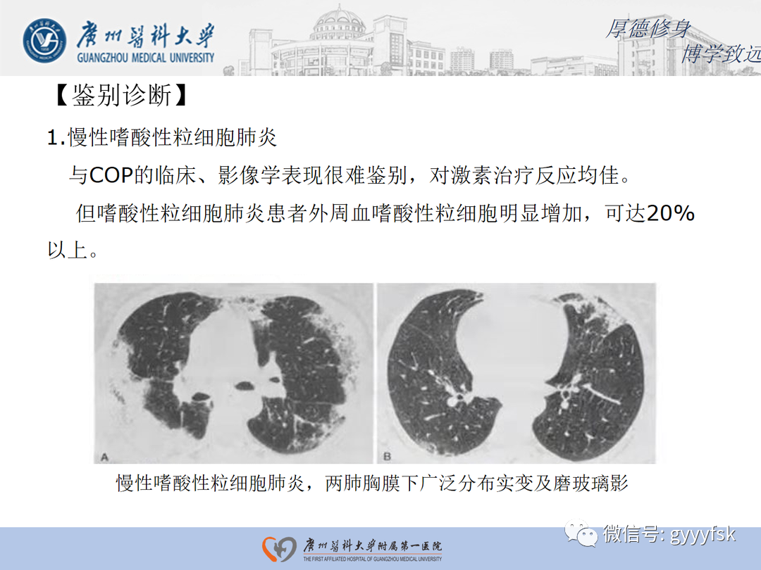 【病例】隐源性机化性肺炎1例CT影像-18