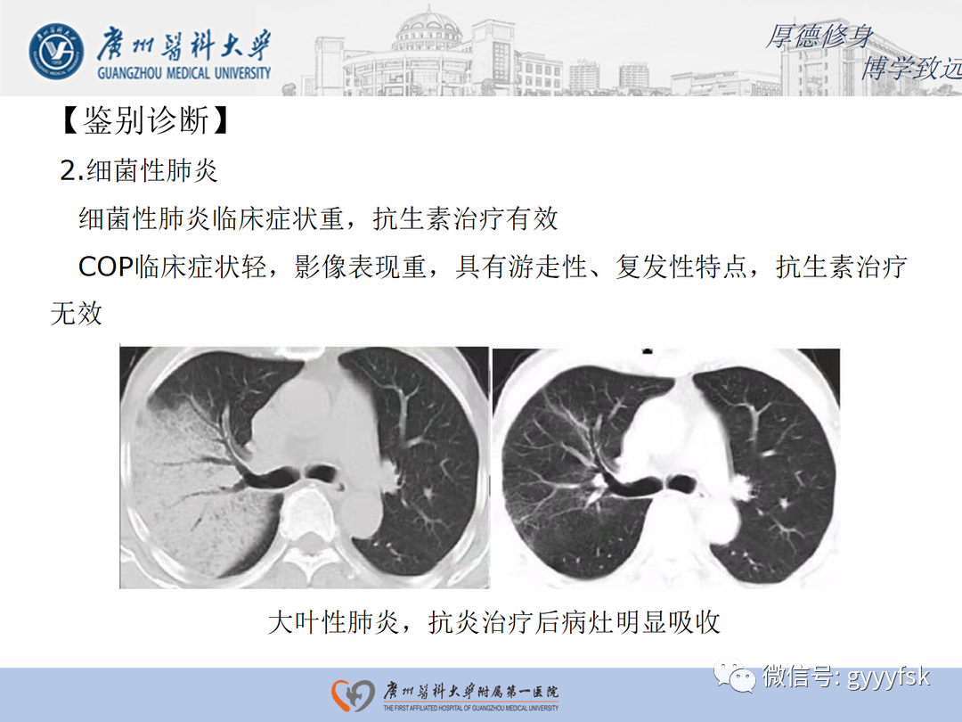 【病例】隐源性机化性肺炎1例CT影像-19