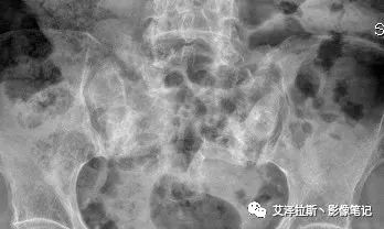 【病例】骶骨功能不全骨折/衰竭骨折2例X线CT影像-1