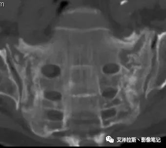 【病例】骶骨功能不全骨折/衰竭骨折2例X线CT影像-2