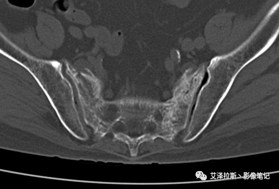 【病例】骶骨功能不全骨折/衰竭骨折2例X线CT影像-3