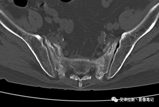【病例】骶骨功能不全骨折/衰竭骨折2例X线CT影像-4