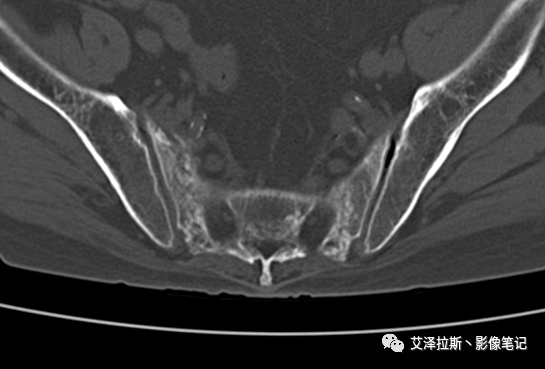 【病例】骶骨功能不全骨折/衰竭骨折2例X线CT影像-5