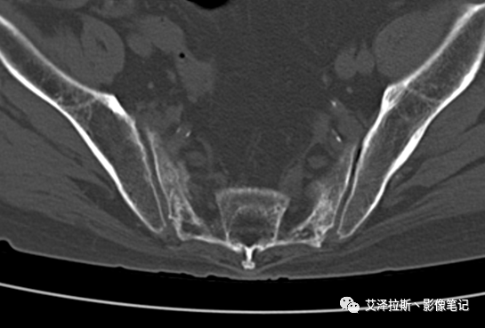 【病例】骶骨功能不全骨折/衰竭骨折2例X线CT影像-6