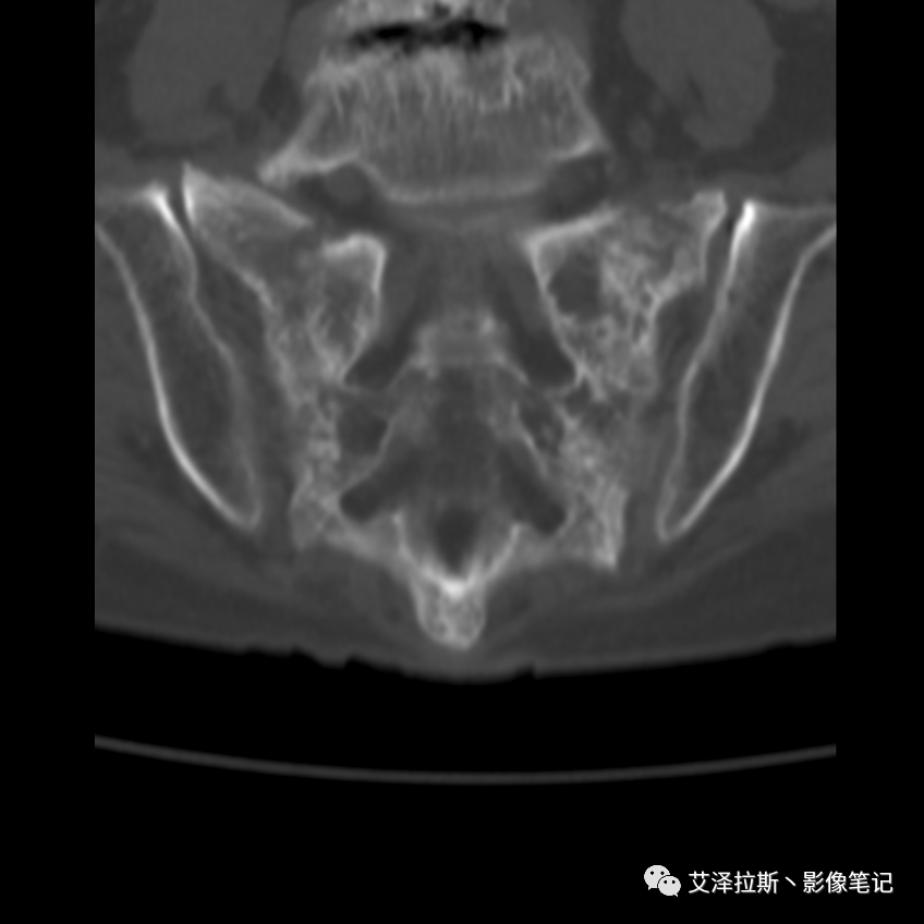 【病例】骶骨功能不全骨折/衰竭骨折2例X线CT影像-7