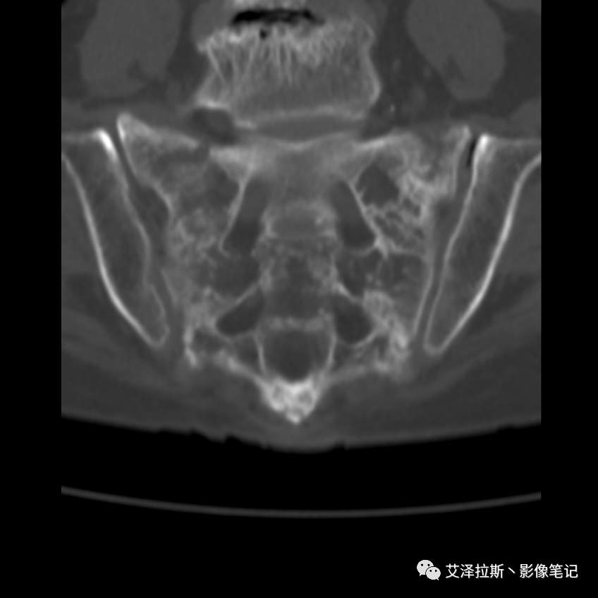 【病例】骶骨功能不全骨折/衰竭骨折2例X线CT影像-8