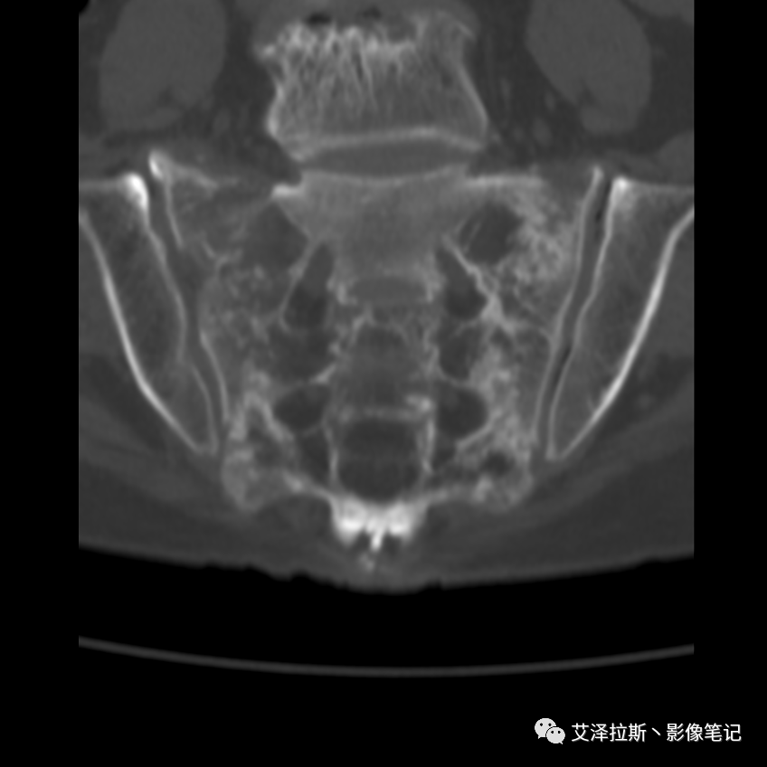 【病例】骶骨功能不全骨折/衰竭骨折2例X线CT影像-9