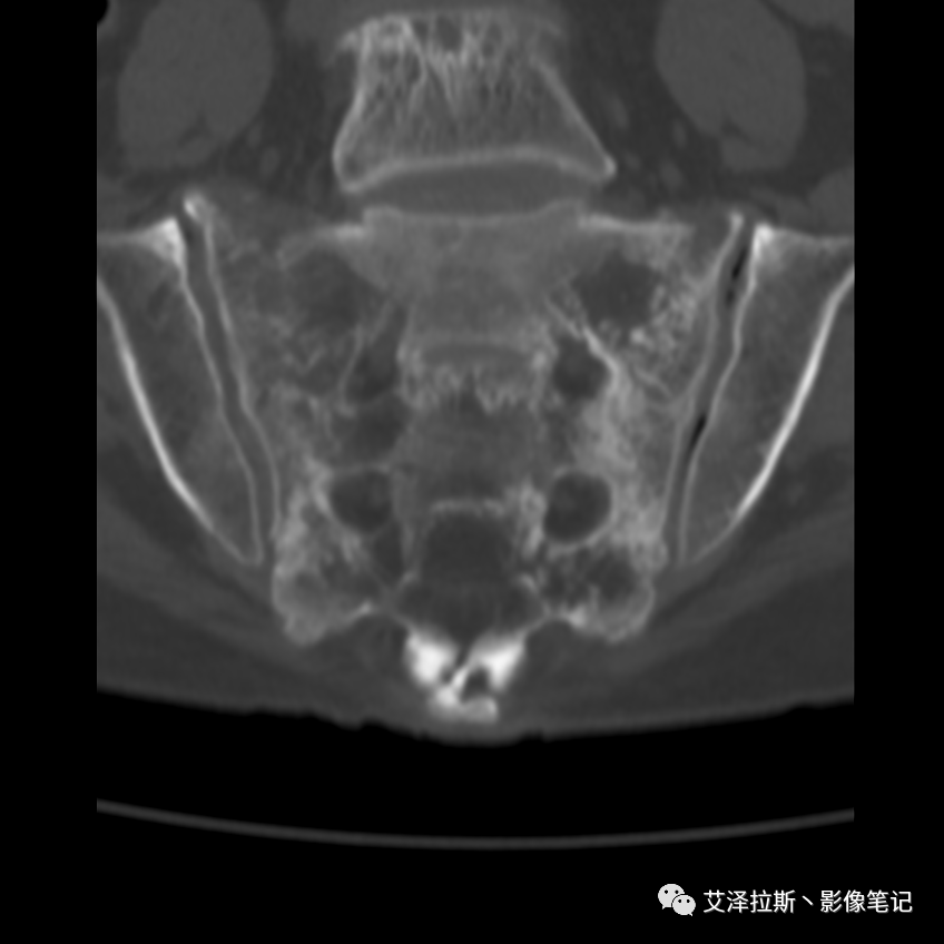 【病例】骶骨功能不全骨折/衰竭骨折2例X线CT影像-10