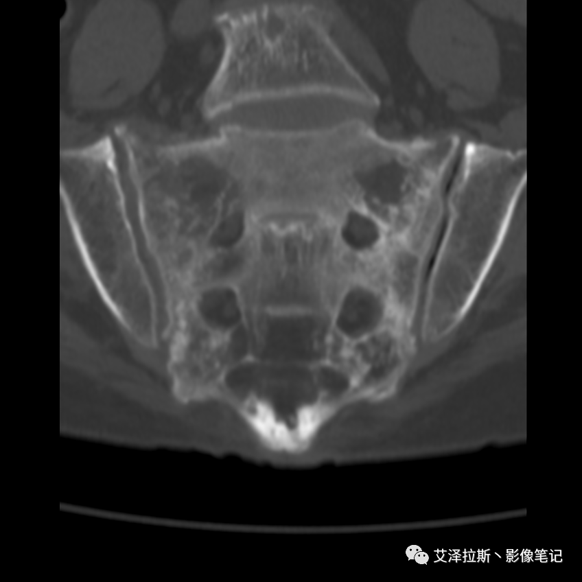 【病例】骶骨功能不全骨折/衰竭骨折2例X线CT影像-11