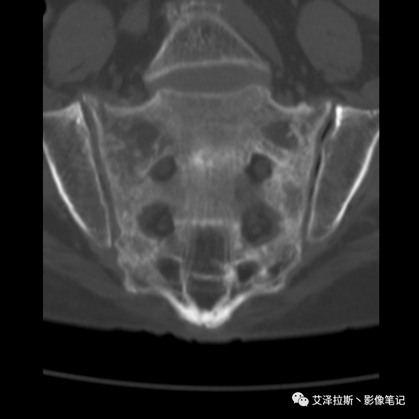 【病例】骶骨功能不全骨折/衰竭骨折2例X线CT影像-12