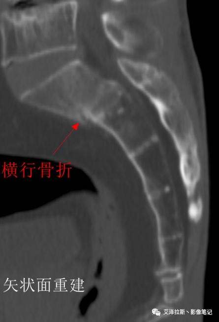 【病例】骶骨功能不全骨折/衰竭骨折2例X线CT影像-13
