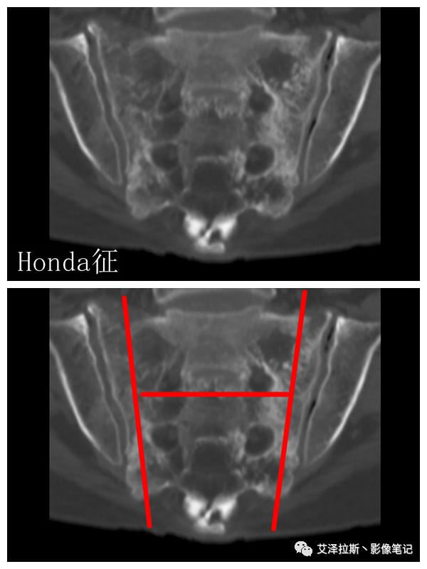 【病例】骶骨功能不全骨折/衰竭骨折2例X线CT影像-14