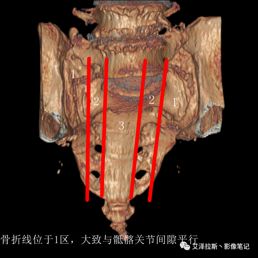 【病例】骶骨功能不全骨折/衰竭骨折2例X线CT影像-15