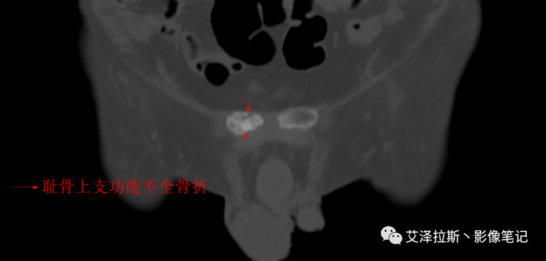 【病例】骶骨功能不全骨折/衰竭骨折2例X线CT影像-16