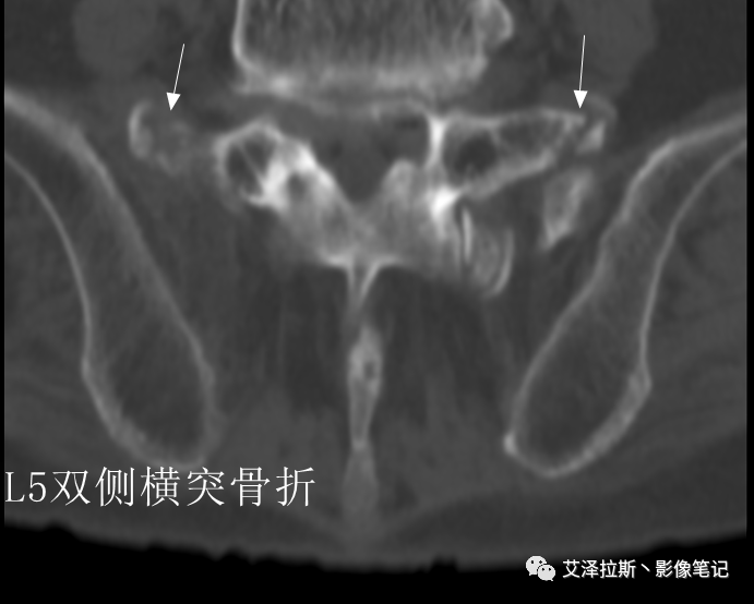 【病例】骶骨功能不全骨折/衰竭骨折2例X线CT影像-17