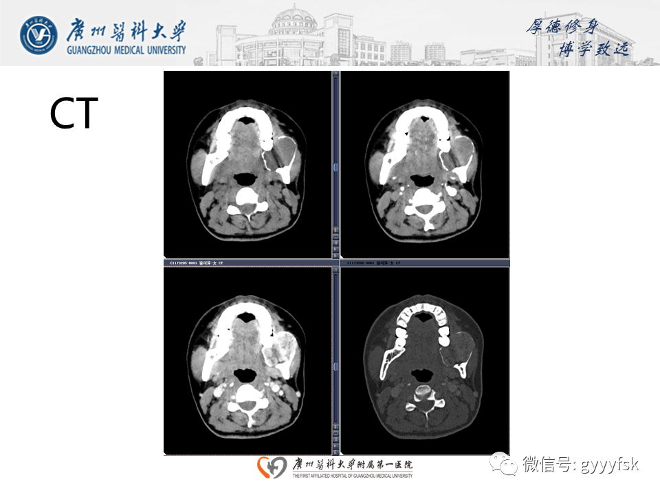 【病例】成釉细胞瘤 VS 牙源性囊肿-4