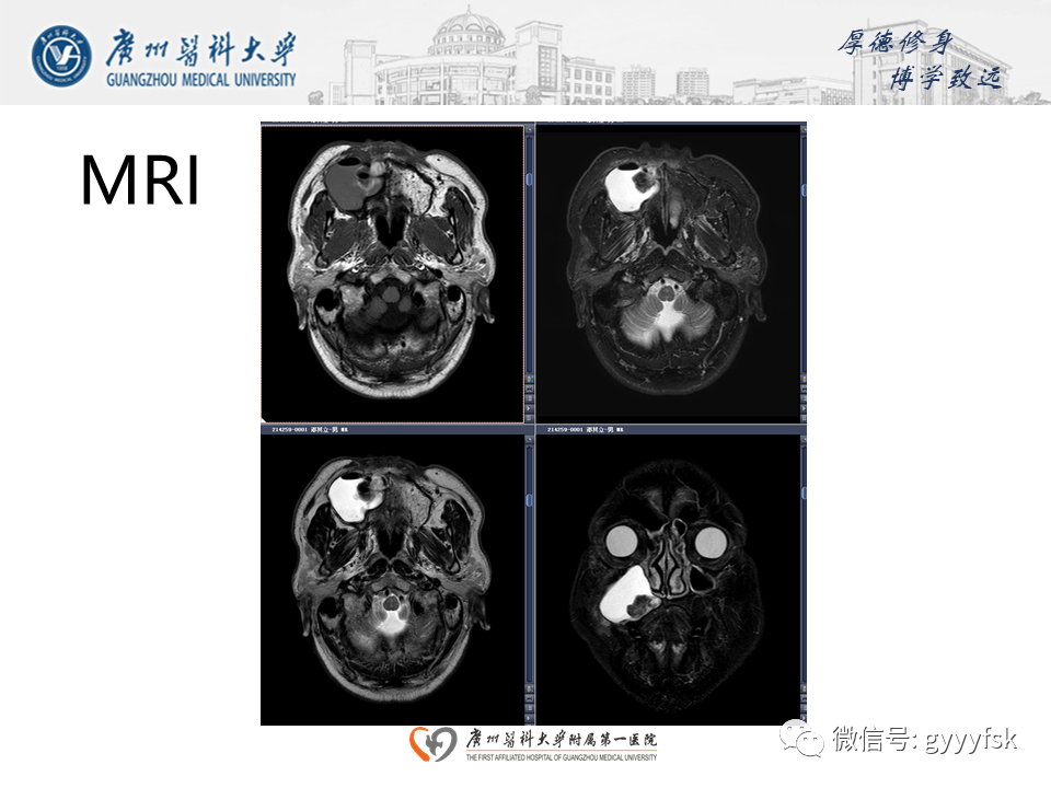 【病例】成釉细胞瘤 VS 牙源性囊肿-9