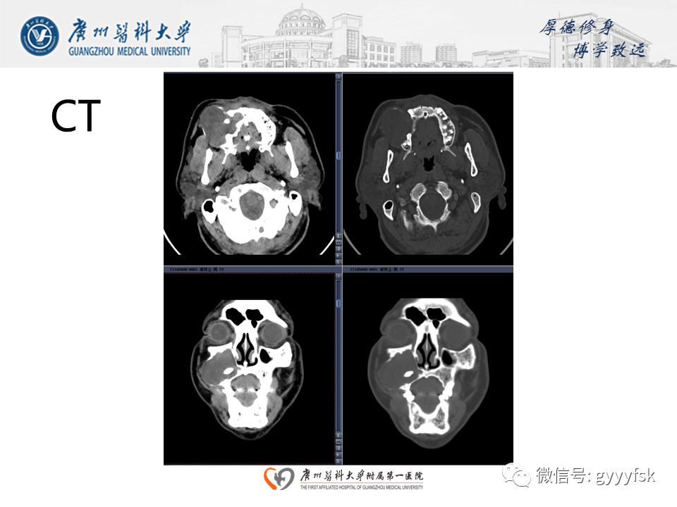 【病例】成釉细胞瘤 VS 牙源性囊肿-8
