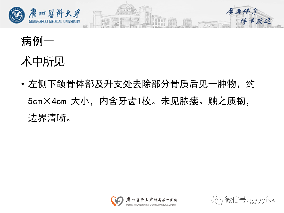 【病例】成釉细胞瘤 VS 牙源性囊肿-11