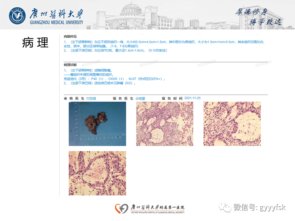 【病例】成釉细胞瘤 VS 牙源性囊肿-12