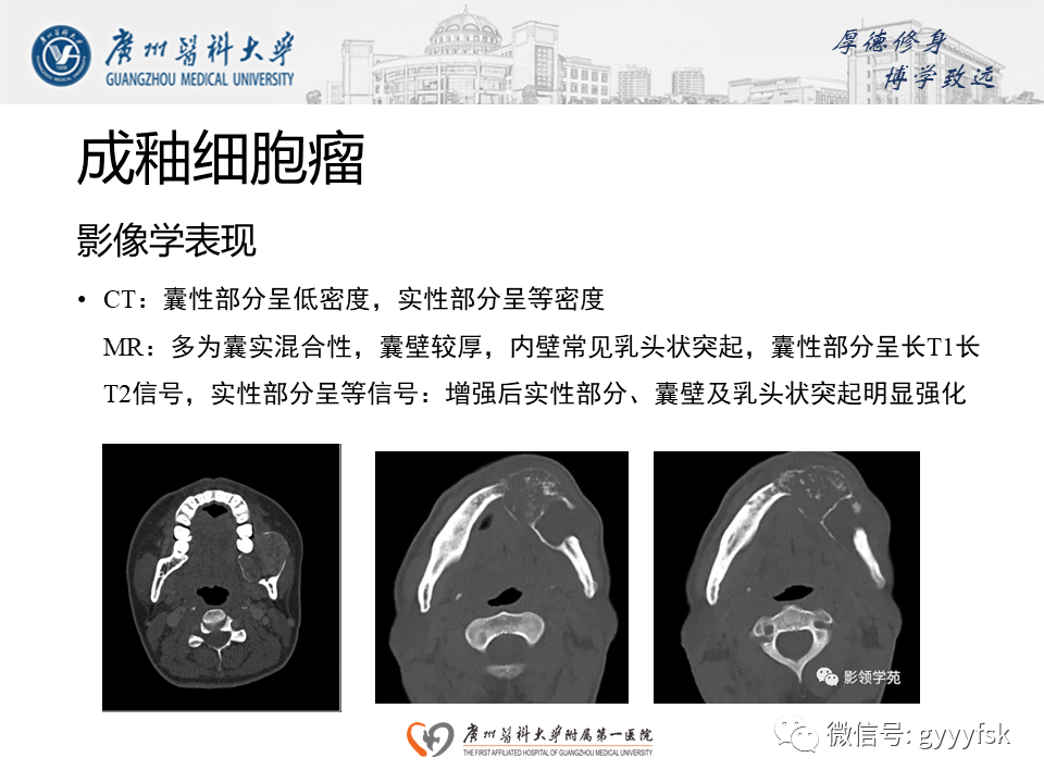 【病例】成釉细胞瘤 VS 牙源性囊肿-18