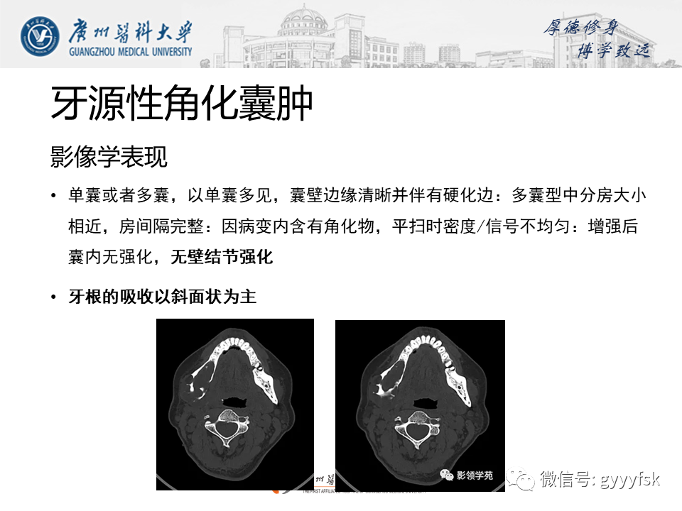 【病例】成釉细胞瘤 VS 牙源性囊肿-20