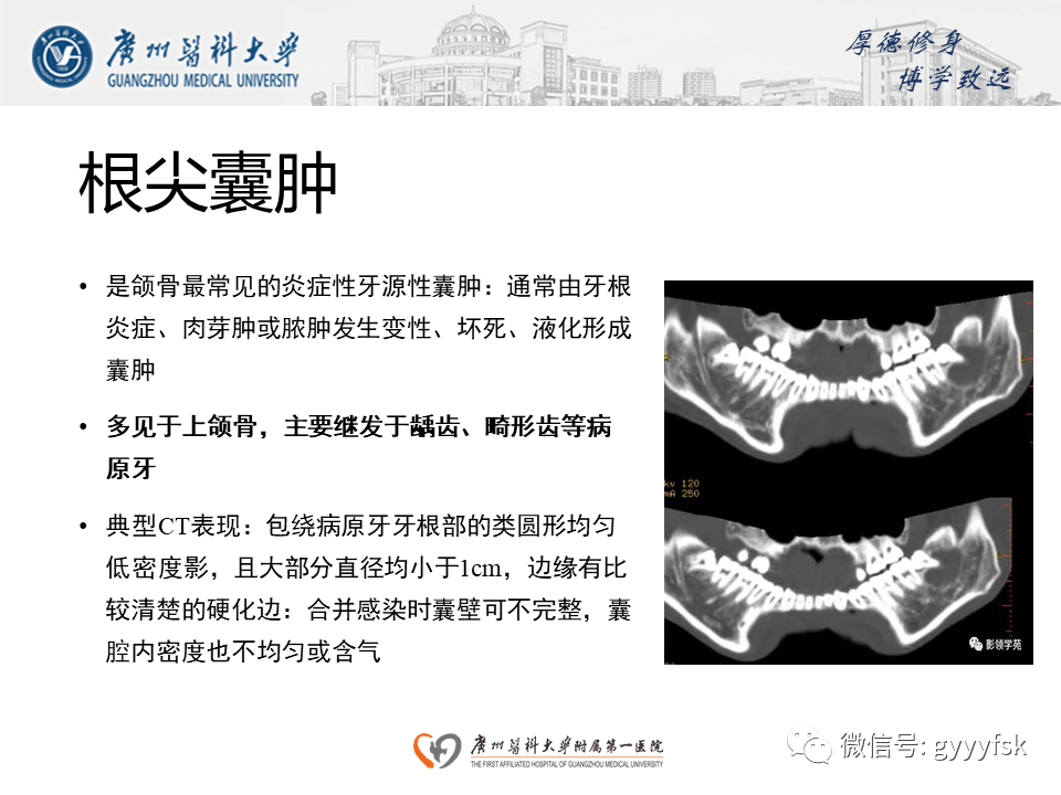 【病例】成釉细胞瘤 VS 牙源性囊肿-21