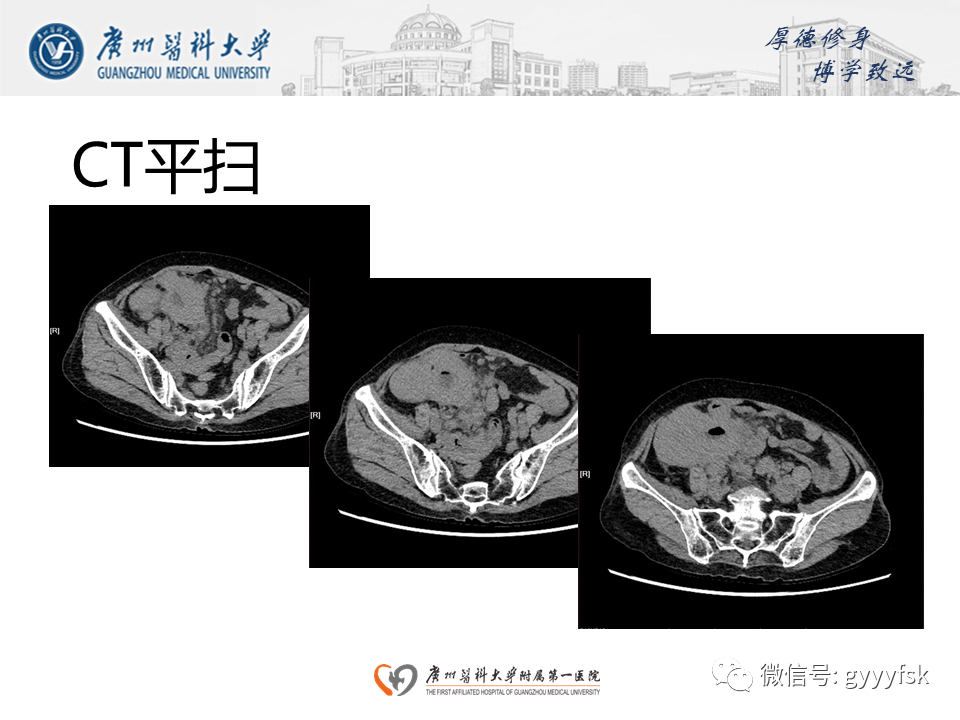 【病例】胃肠道淋巴瘤1例CT影像-7