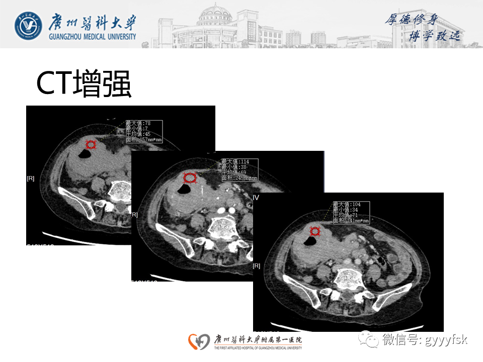 【病例】胃肠道淋巴瘤1例CT影像-8