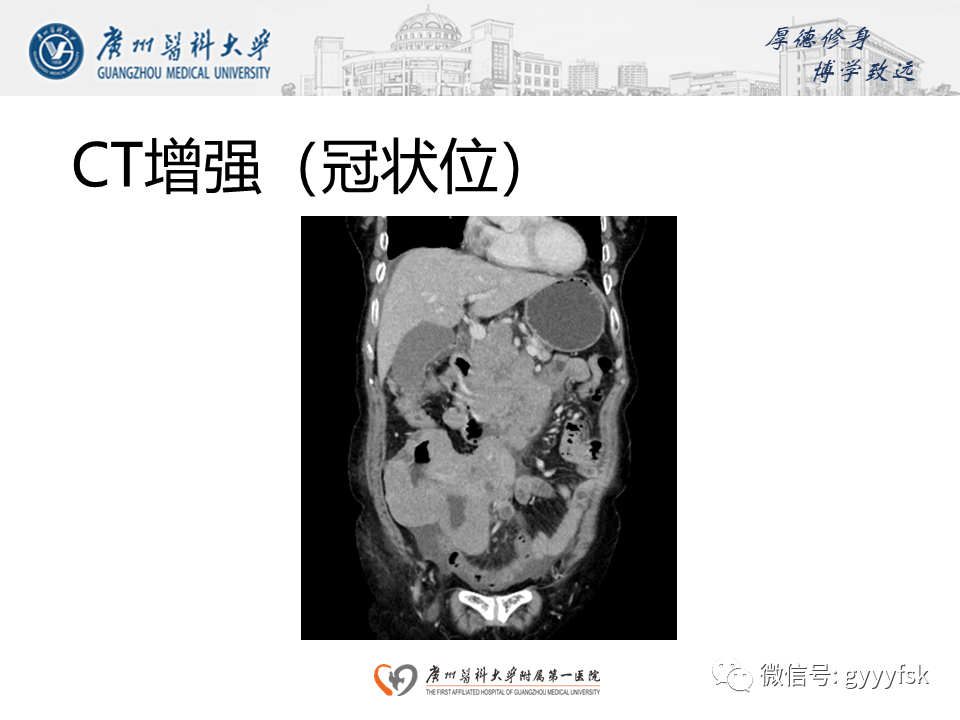 【病例】胃肠道淋巴瘤1例CT影像-9
