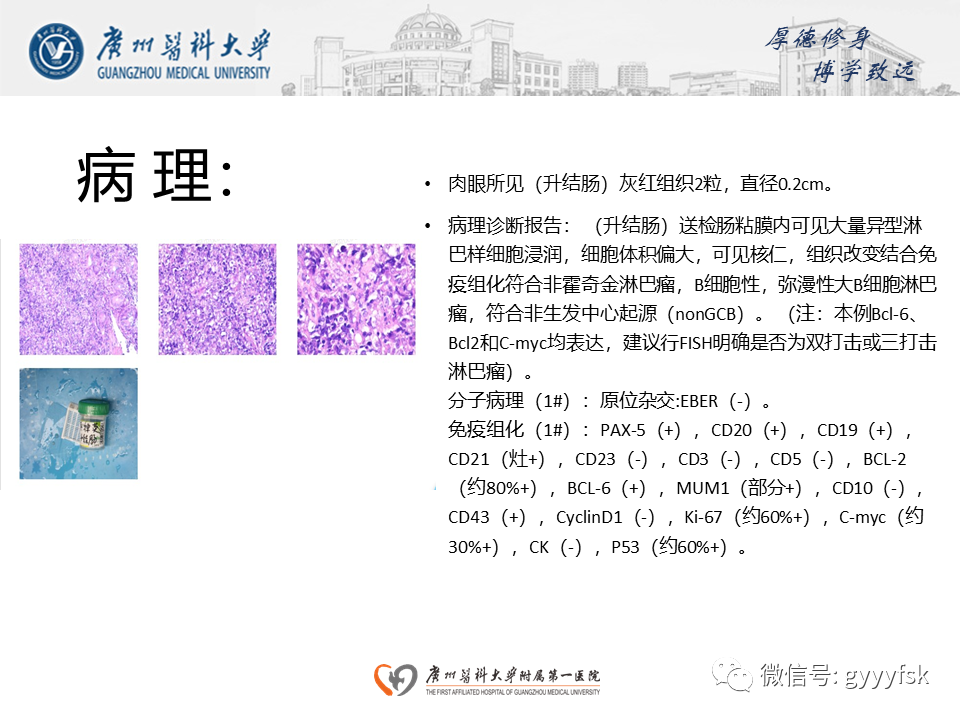 【病例】胃肠道淋巴瘤1例CT影像-11