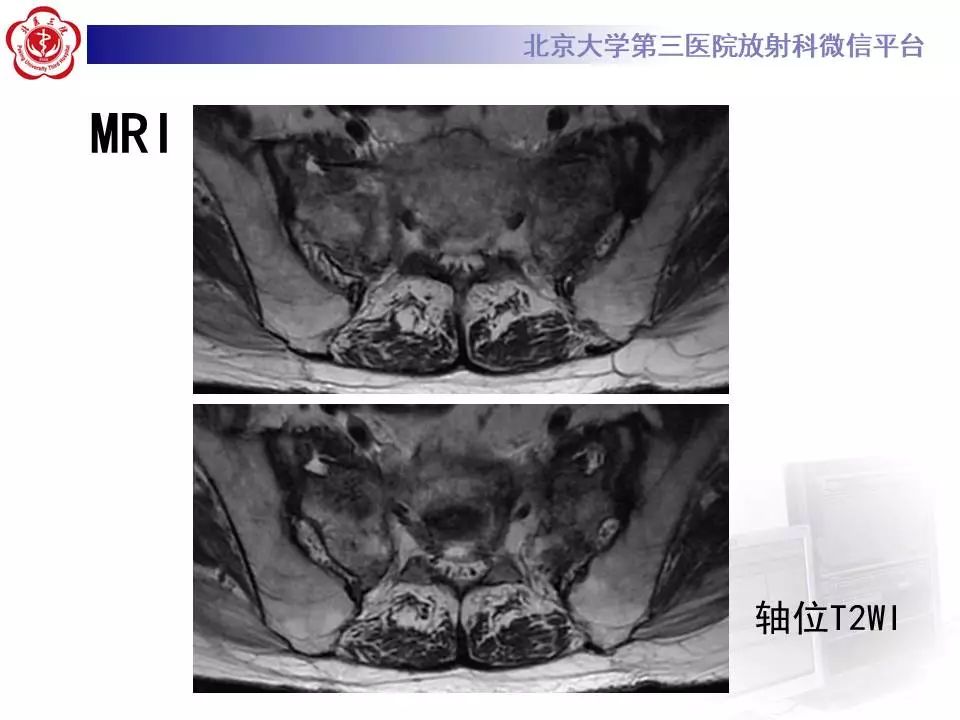 【PPT】骶骨不全骨折-5
