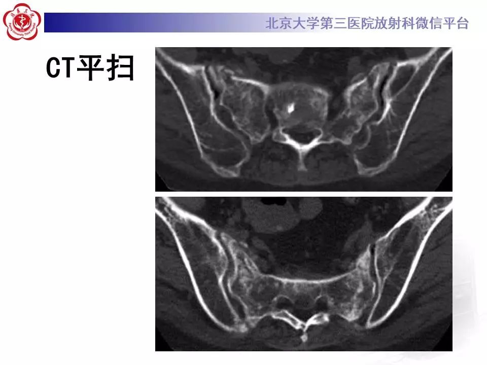 【PPT】骶骨不全骨折-3