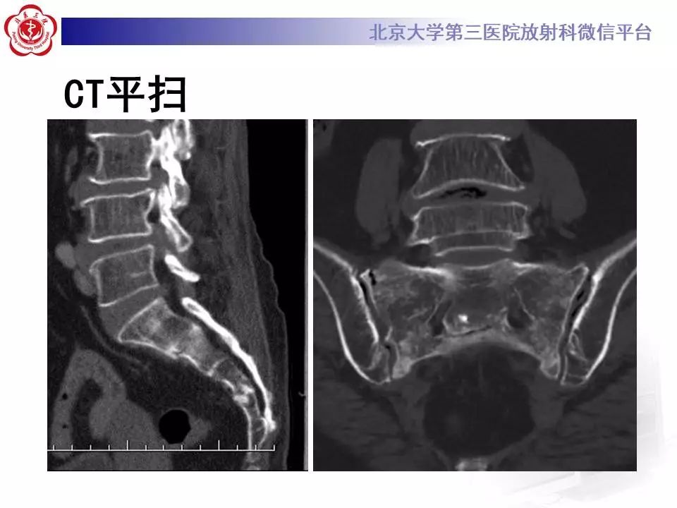 【PPT】骶骨不全骨折-4