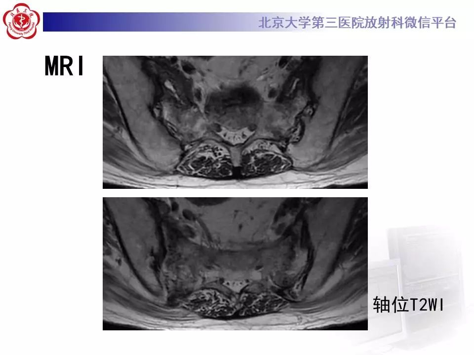 【PPT】骶骨不全骨折-6