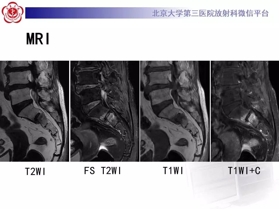 【PPT】骶骨不全骨折-7