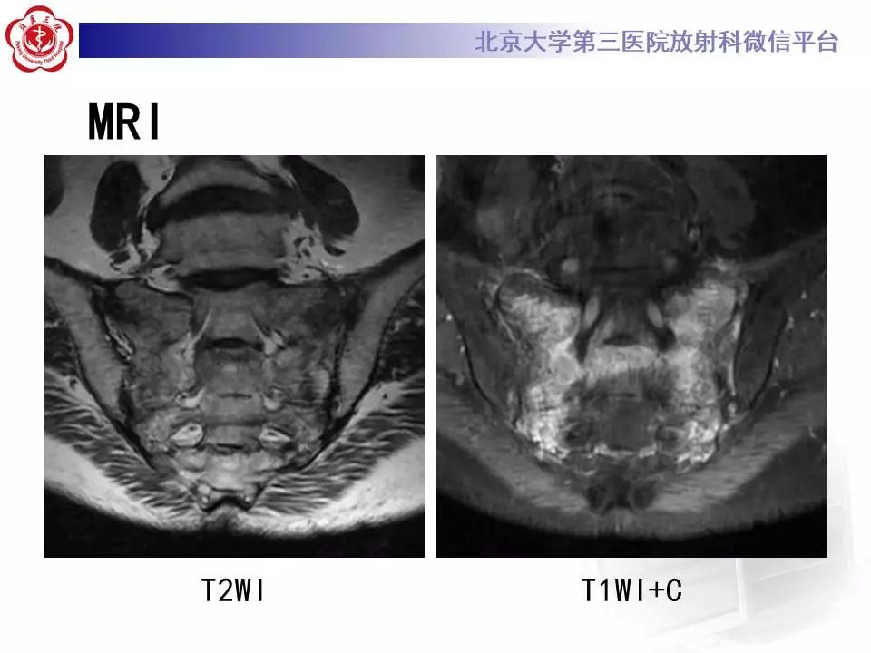 【PPT】骶骨不全骨折-8