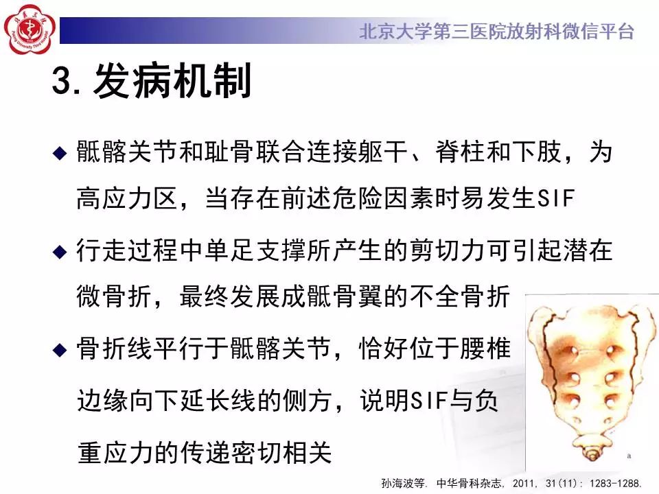【PPT】骶骨不全骨折-14
