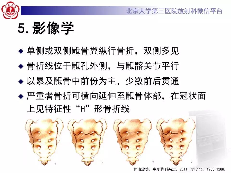 【PPT】骶骨不全骨折-17