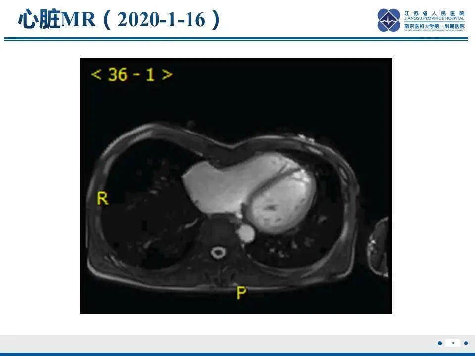 【PPT】直背综合征-7
