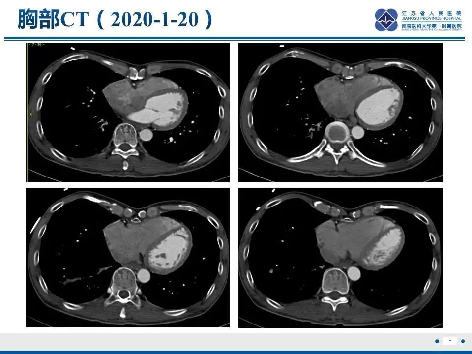 【PPT】直背综合征-8