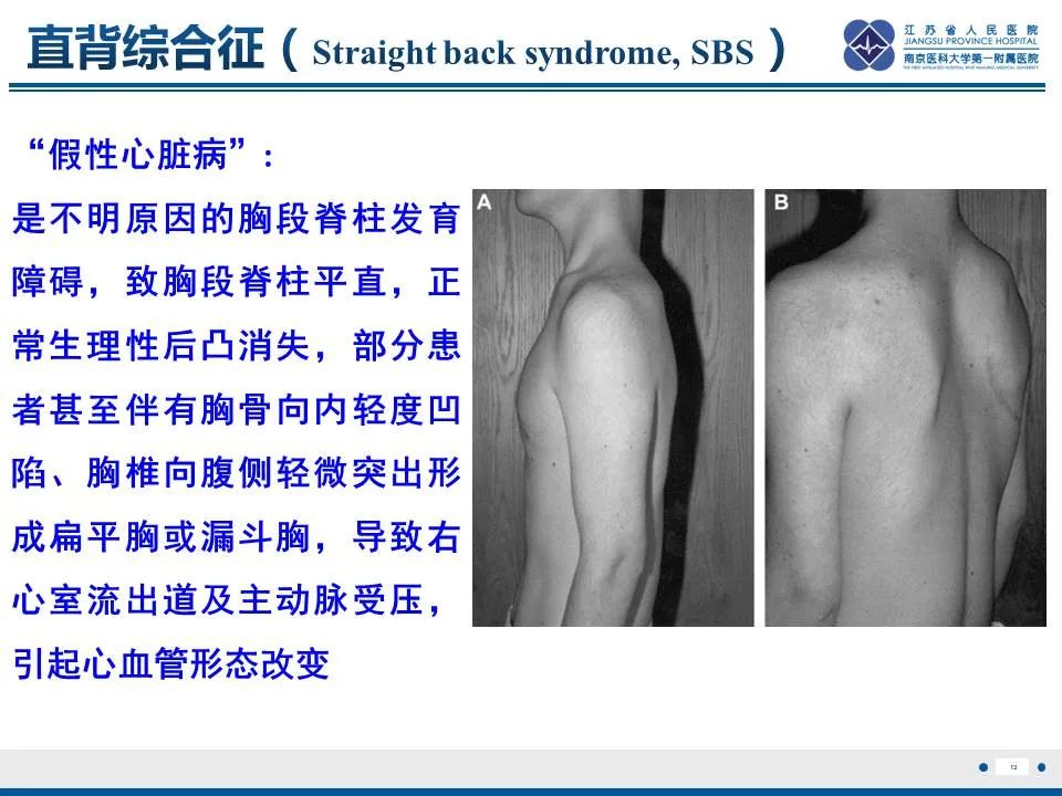 【PPT】直背综合征-14