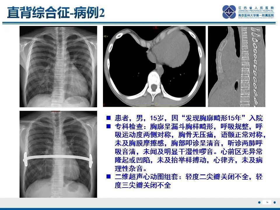 【PPT】直背综合征-15