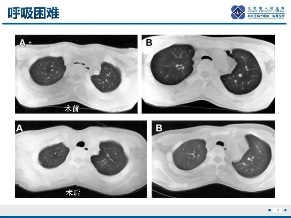 【PPT】直背综合征-20